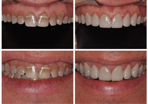 Smile Makeover: The Best Way to Fix Stained or Discolored Teeth