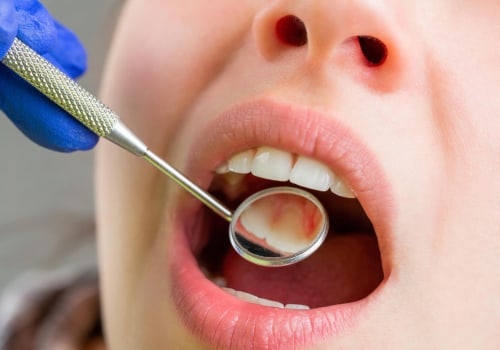 5 Questions to Ask Your Dentist Before Getting a Smile Makeover