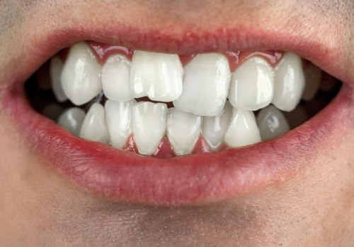 Can a Smile Makeover Fix Crooked Teeth?