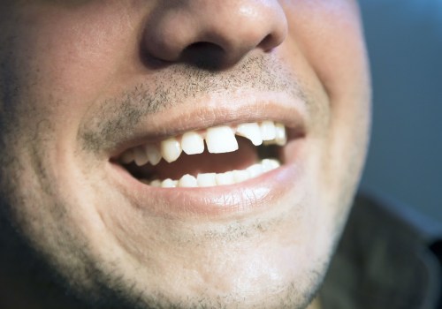 A Smile Makeover: The Perfect Solution for Chipped or Broken Teeth