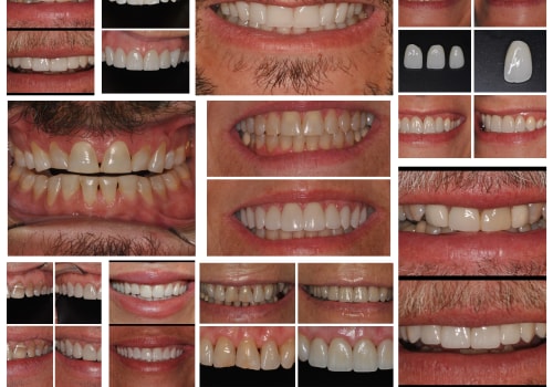 Maintaining Your Smile Makeover: What You Need to Know