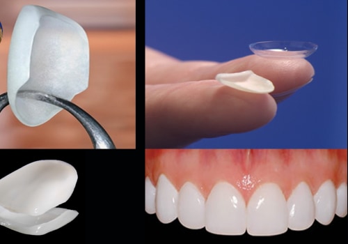 Enhance Your Appearance With Porcelain Veneers: The Ultimate Smile Makeover In Round Rock