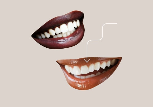 What Age is Best for a Smile Makeover?